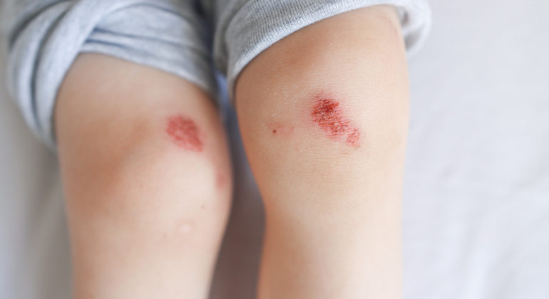 The image shows a close-up of two knees with signs of frostbite, a potential side effect of cryotherapy. The skin on both knees displays red, raw patches, indicative of frostbite damage caused by exposure to extreme cold temperatures. The affected areas appear tender and irritated, emphasizing the risks associated with improper cryotherapy procedures. The image serves as a reminder of the importance of carefully monitoring skin exposure during cryotherapy to prevent such injuries.