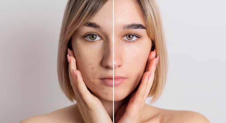 Before and after image of a woman showing noticeable skin improvement, with the left side displaying acne and blemishes, and the right side showing clear, smooth, and radiant skin.