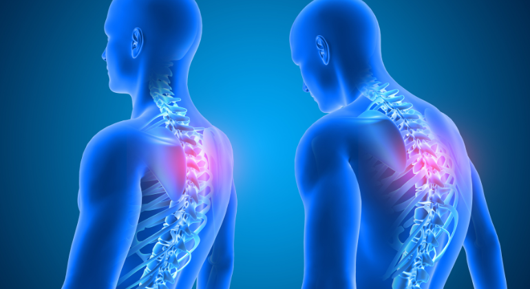 A 3D illustration of the human spine highlighting areas of strain and misalignment in the upper back. The image represents the impact of postural imbalances, possibly linked to conditions like navel displacement or poor core stability.