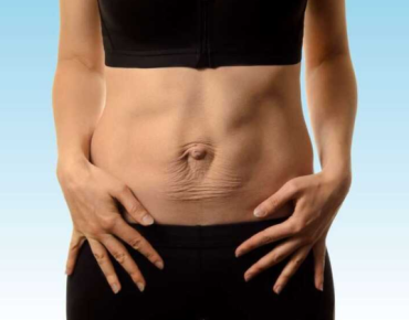 A person showing their abdominal area with visible signs of muscle weakness or misalignment, possibly related to navel displacement. The image highlights the impact of abdominal strain on core stability and posture.